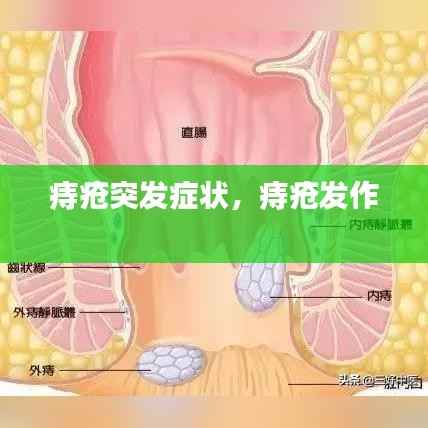 痔疮突发症状,痔疮发作